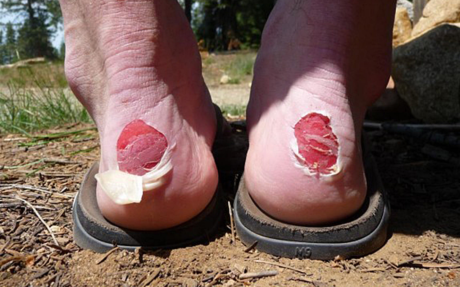 Shoes Causing Blisters on the Back of Heel: Causes, Solutions, and Prevention