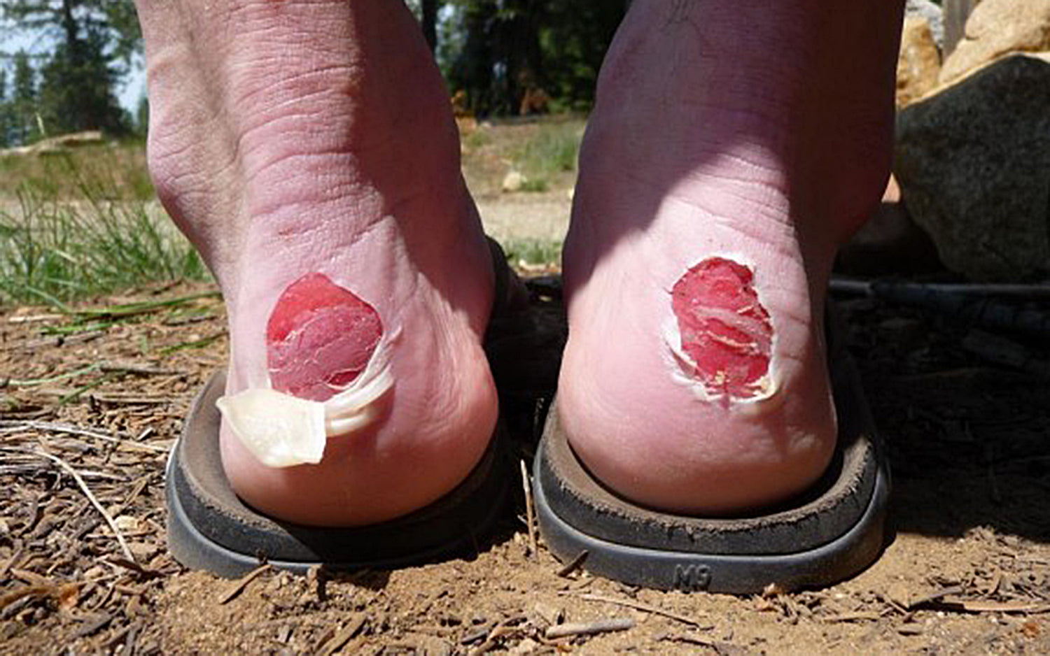 Causes of Blisters on Heels